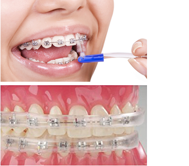 ortodoncija higijena