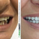 totalna proteza vita zubi