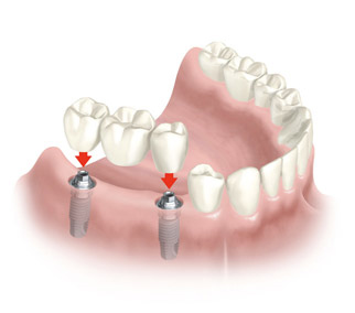 Rešenje implantom most na implantima